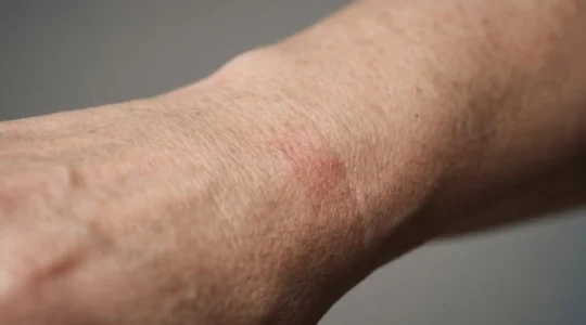 Gros plan sur une peau mature montrant une légère réaction cutanée au contact d'un bijou, représentant les allergies dermatologiques liées aux alliages métalliques après 40 ans